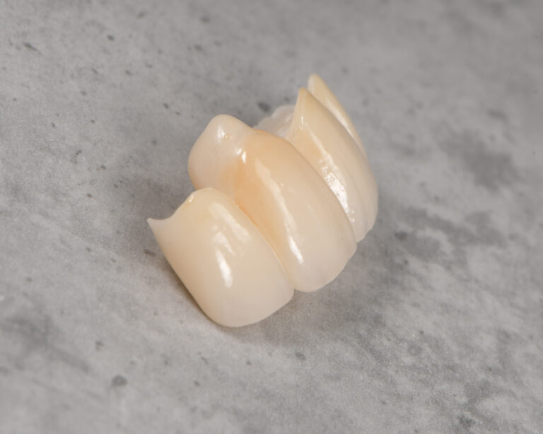 Most adhezyjny porcelanowy przeznaczony do trwałego uzupełnienia braków zębowych