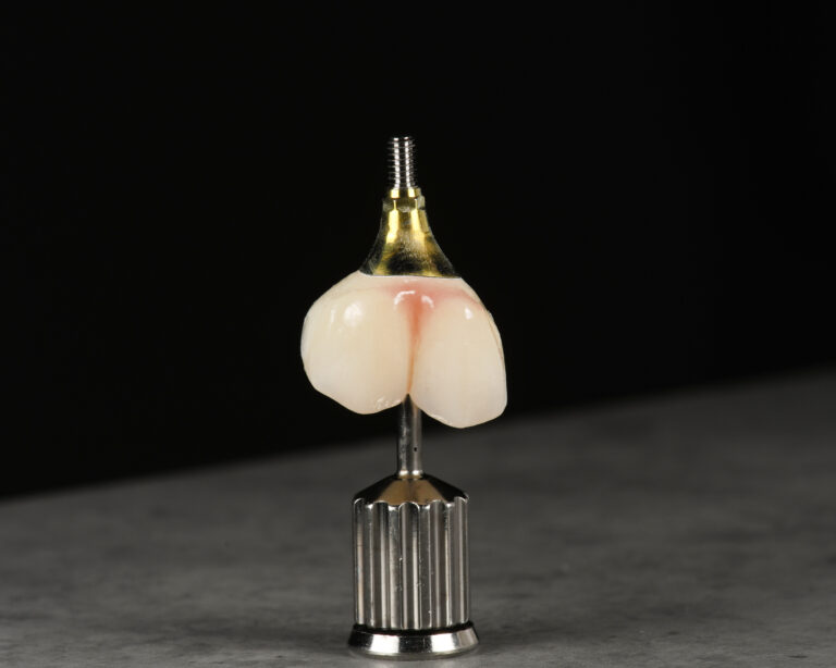 Korona protetyczna na implant z tytanową bazą przygotowana w laboratorium dentystycznym